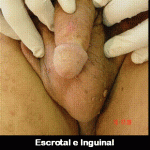 escrotal