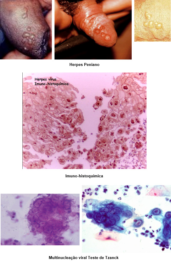 herpes genital y papiloma