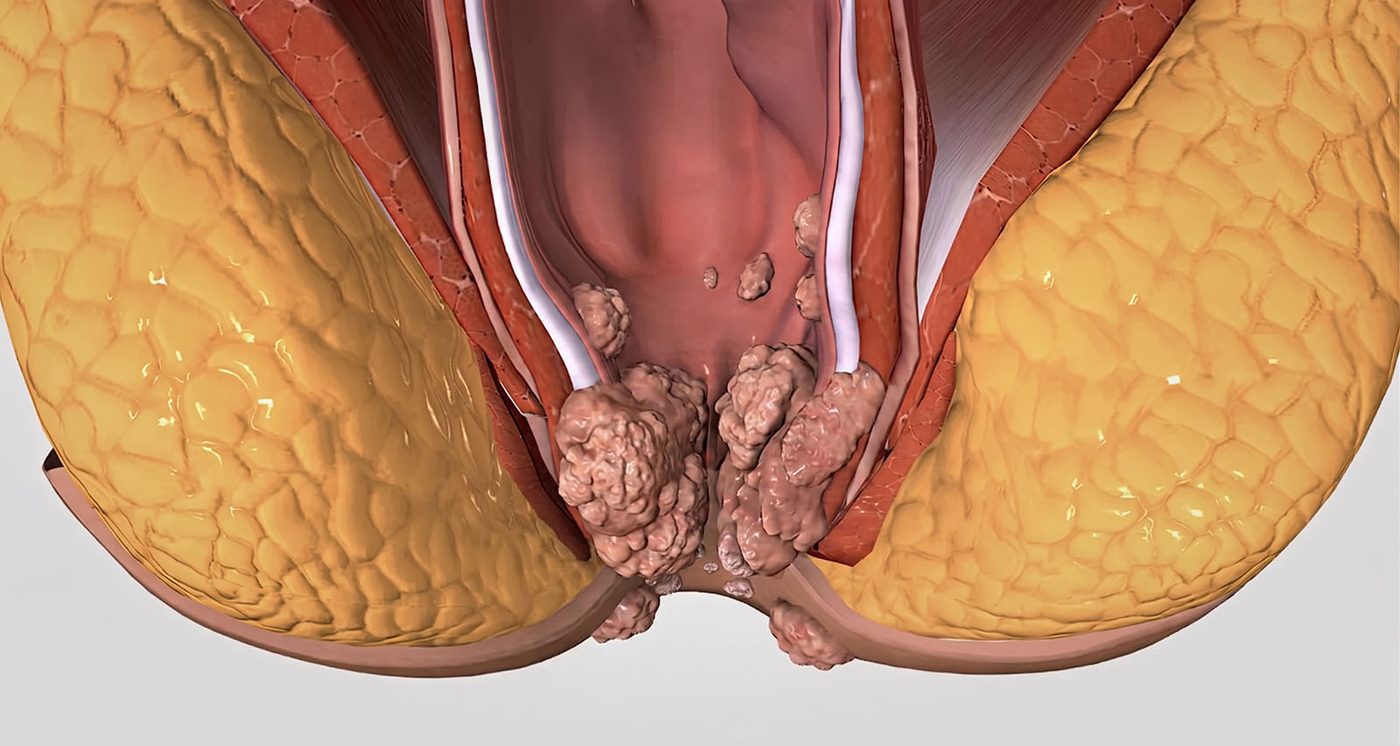 HPV e Verrugas Anais