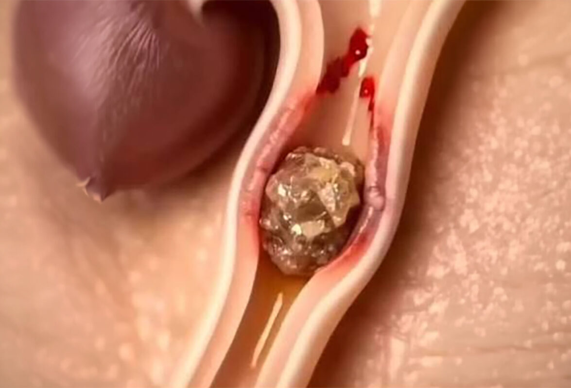 pedra-no-ureter