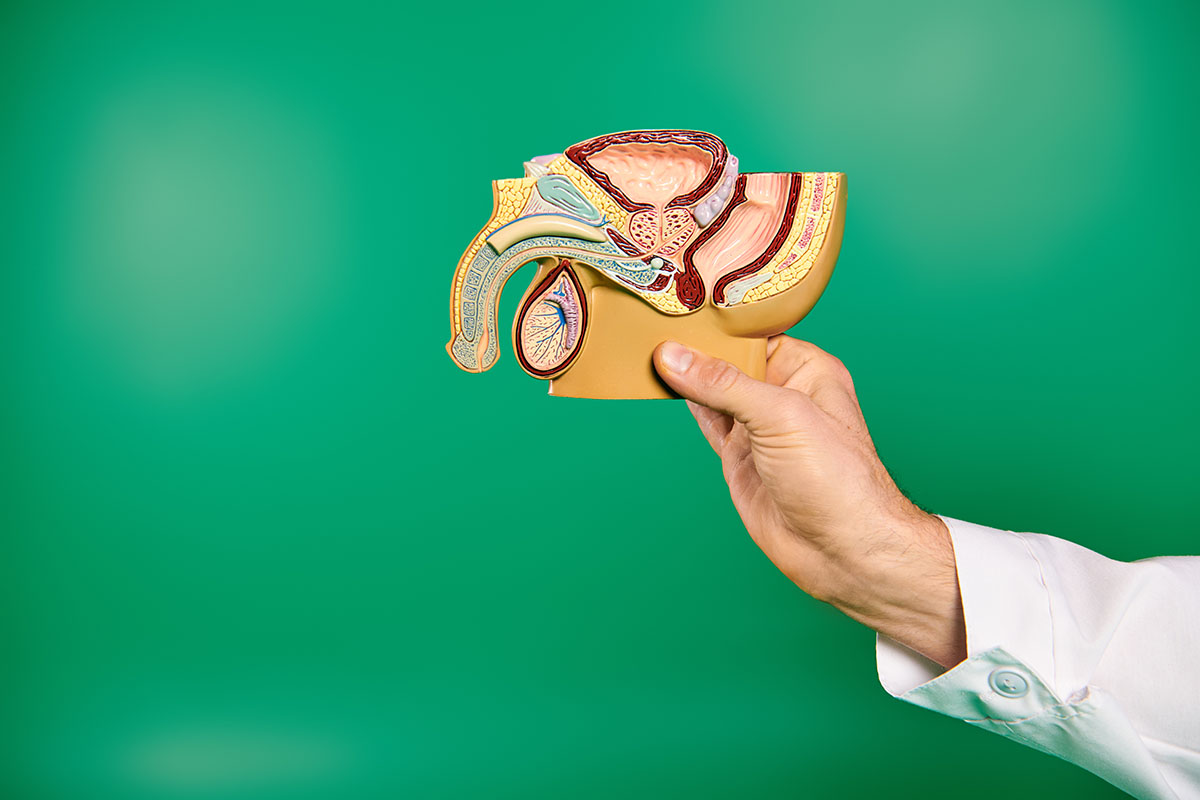 varicocele
